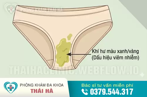 Dịch âm đạo nhiễm lậu cầu có màu vàng xanh đặc trưng.
