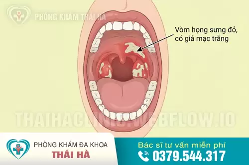Lậu cầu khuẩn gây viêm loét, mưng mủ tại vùng họng.