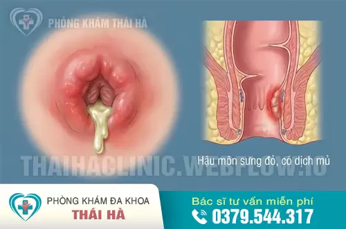 Hậu môn bị viêm nhiễm, chảy dịch do lậu.