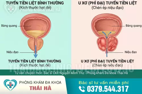 Hình ảnh so sánh Tuyến tiền liệt bình thường và Khi bị U xơ