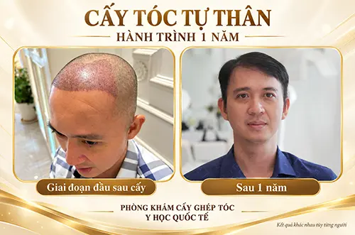 Khách hàng cấy tóc tự thân sau 1 năm tại phòng khám cấy tóc y học quốc tế