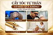 Cấy tóc tự thân có hiệu quả không? 4 yếu tố quyết định