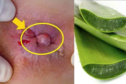 Bị trĩ sau sinh chữa bằng nha đam