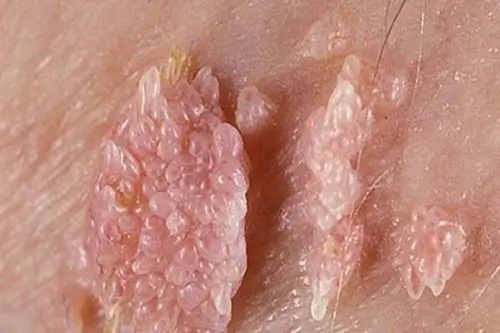 Bệnh sùi mào gà là gì?