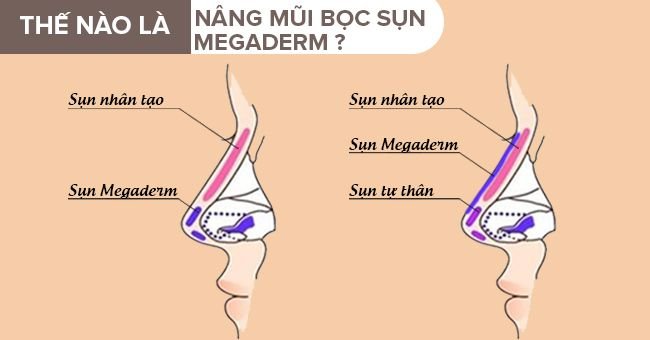 Chăm sóc sau khi nâng mũi bọc sụn megaderm