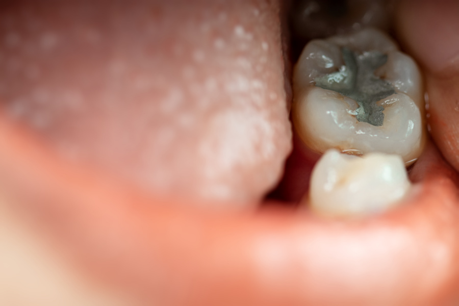 If tooth decay is extensive, or located on the back teeth, white fillings will wear off quicker than silver fillings