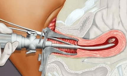 Chi phí hút thai hết bao nhiêu tiền