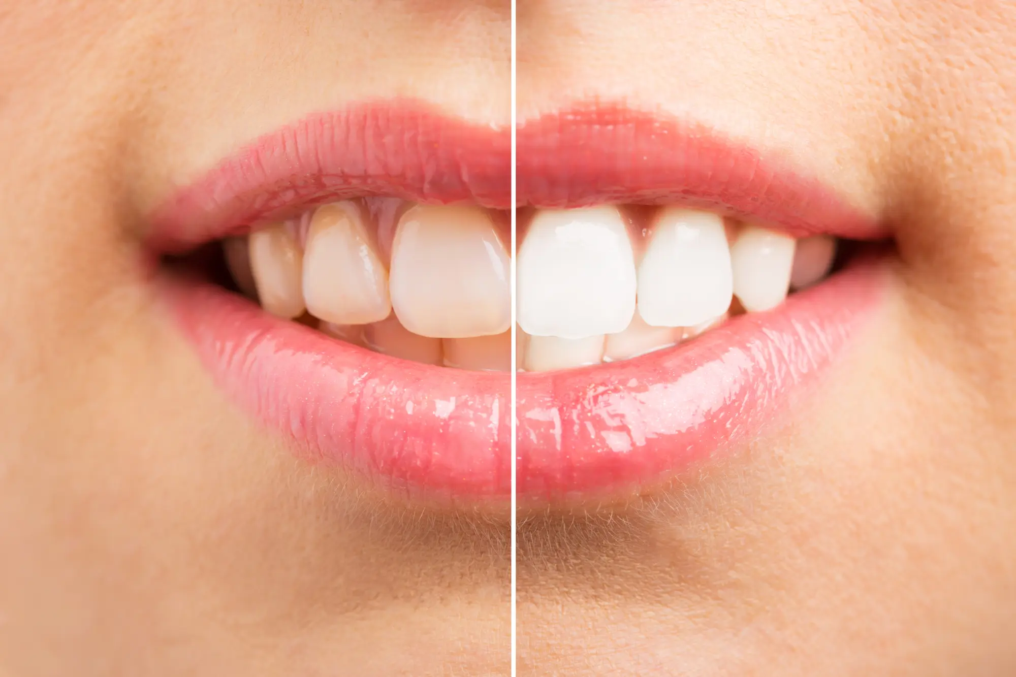 Brighten Your Smile: Professional Teeth Whitening vs. Over-the-Counter Kits