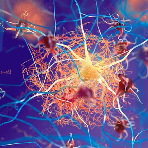 Artist's impression shows amyloid plaques forming between neurons