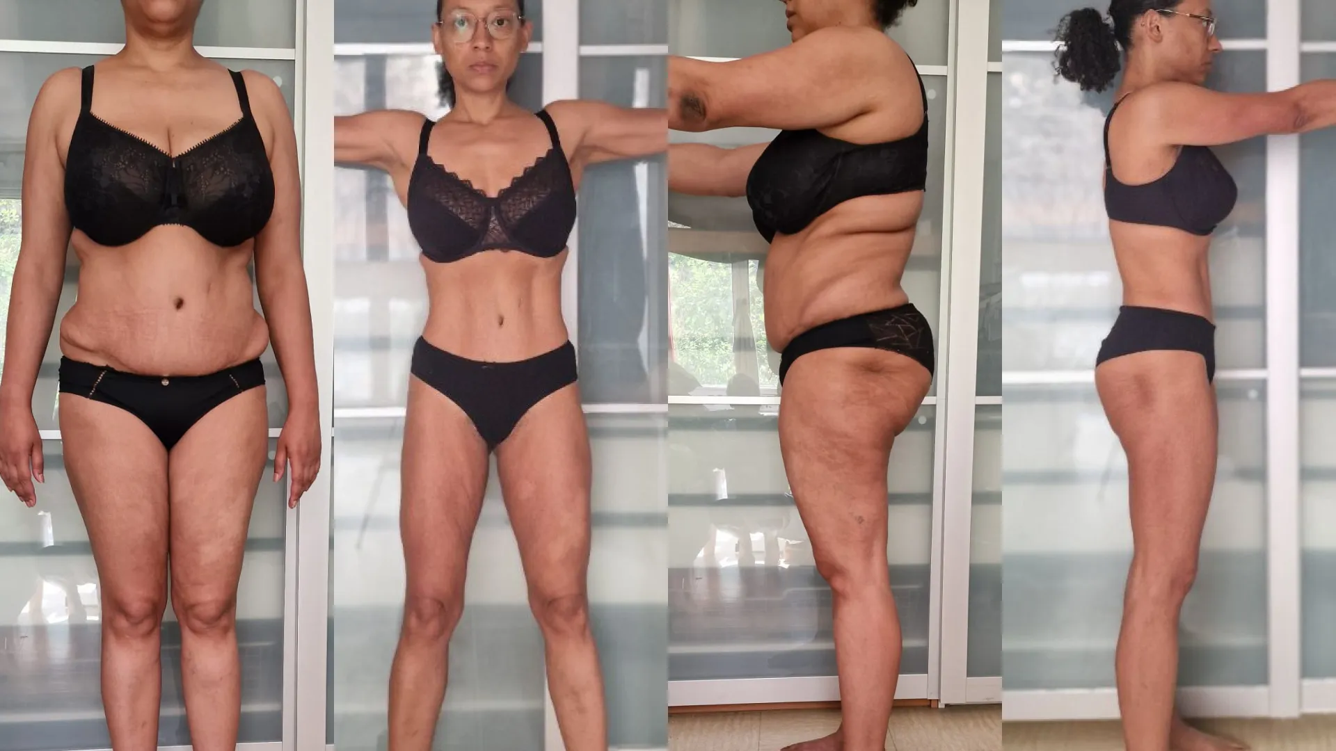 Avant/après femme de 50 ans cellulite.