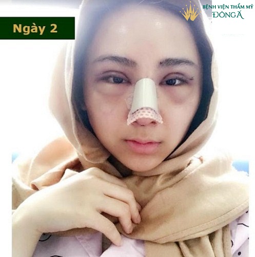 Nâng mũi mấy ngày tháo băng? Có nên tự tháo băng tại nhà không? Hình 2