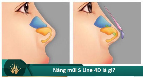 Nâng mũi S Line 4D - Giá tiền đi liền Chất Lượng - Đẹp Vĩnh Viễn - Hình 2