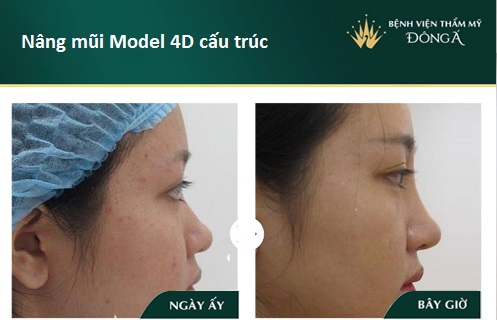 Nâng mũi S Line 4D - Giá tiền đi liền Chất Lượng - Đẹp Vĩnh Viễn - Hình 8