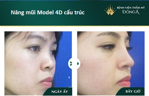 Nâng mũi S Line 4D - Giá tiền đi liền Chất Lượng - Đẹp Vĩnh Viễn - Hình 11
