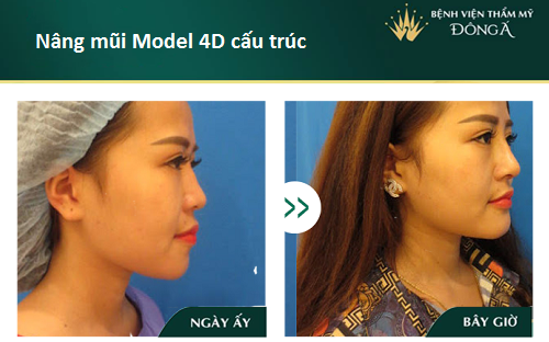 Nâng mũi S Line 4D - Giá tiền đi liền Chất Lượng - Đẹp Vĩnh Viễn - Hình 9