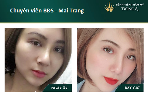Nâng mũi bán cấu trúc - 7 Thông tin cần thiết cho Tín Đồ Làm Đẹp - Hình 8