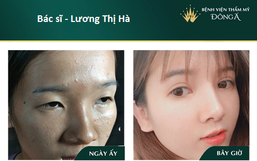 Nâng mũi bán cấu trúc - 7 Thông tin cần thiết cho Tín Đồ Làm Đẹp - Hình 10