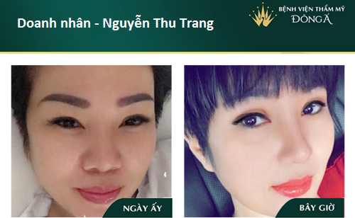 Nâng mũi bán cấu trúc - 7 Thông tin cần thiết cho Tín Đồ Làm Đẹp - Hình 7