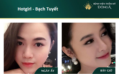 Nâng mũi bán cấu trúc - 7 Thông tin cần thiết cho Tín Đồ Làm Đẹp - Hình 9