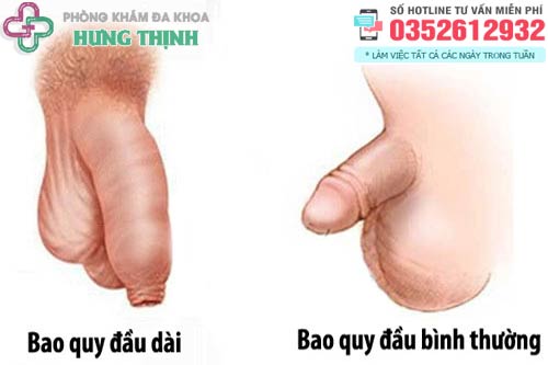 Bao quy đầu dài là gì?