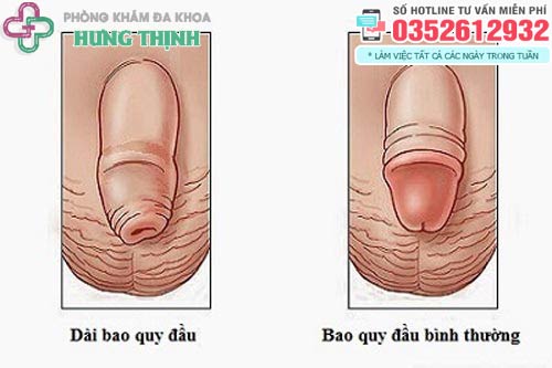 Bao quy đầu dài có ảnh hưởng gì không?