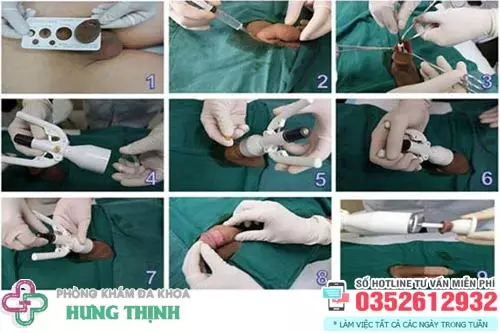 Quy trình cắt bao quy đầu
