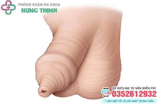 Bao quy đầu chưa lột có quan hệ được không