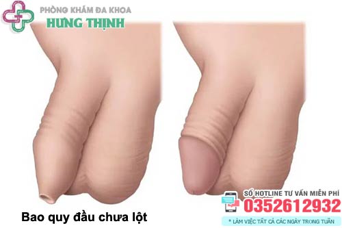 Bao quy đầu chưa lột