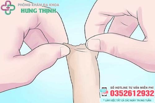 Lột bao quy đầu là gì?