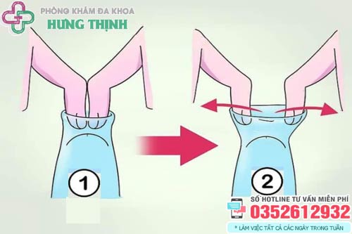 Cách lột bao quy đầu khi bị hẹp
