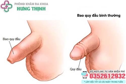 Bao quy đầu như thế nào là bình thường?