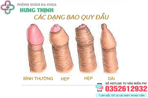 Các bệnh bao quy đầu thường gặp