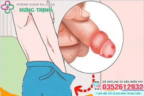 Bao quy đầu bị sưng đỏ và ngứa