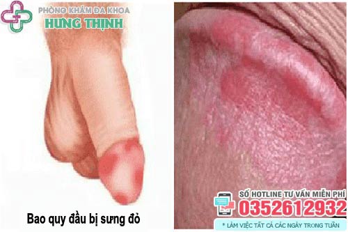 Hình ảnh bao quy đầu bị sưng đỏ ngứa