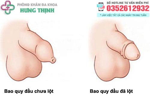 Bao nhiêu tuổi thì lột bao quy đầu cho trẻ