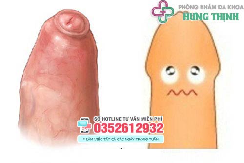 Dính bao quy đầu là gì?