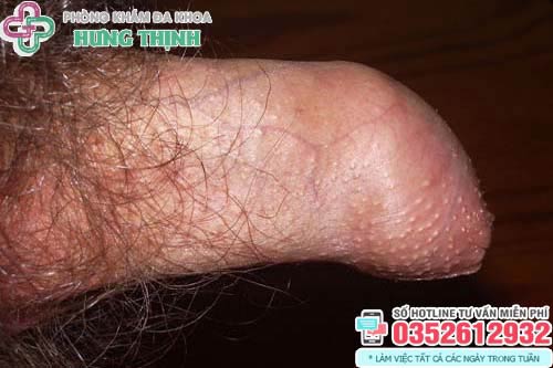 Hình ảnh dính bao quy đầu ở người lớn