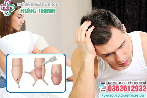 Sau khi cắt bao quy đầu bao lâu được quan hệ