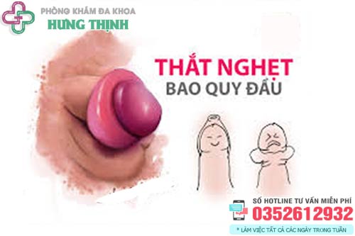Cách chữa nghẹt bao quy đầu tại nhà