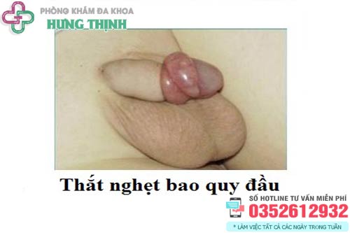 Hình ảnh nghẹt bao quy đầu ở trẻ em