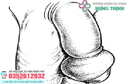 Dấu hiệu nghẹt bao quy đầu