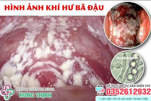 Khí hư màu trắng đục như bã đậu có mùi và ngứa