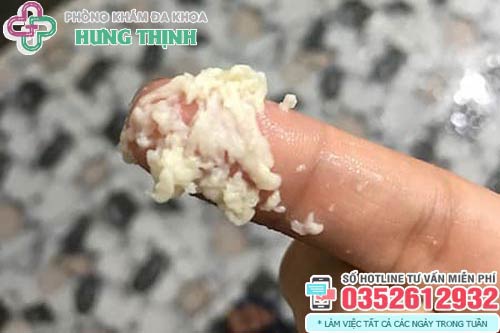 Cách chữa trị khí hư màu trắng đục như bã đậu