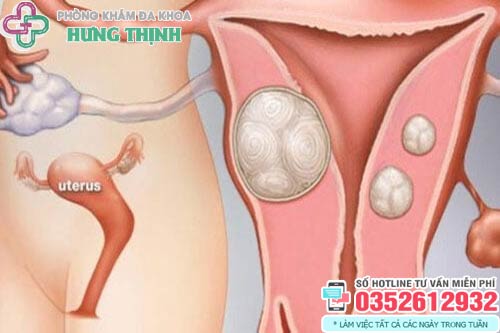 U xơ tử cung