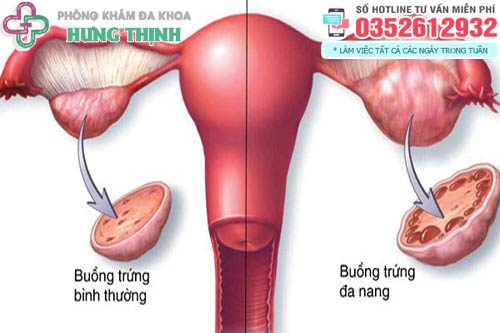 Buồng trứng đa nang