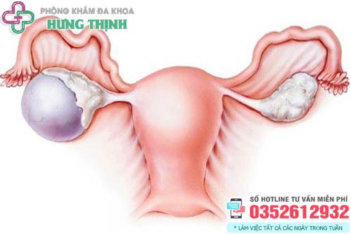 U nang buồng trứng