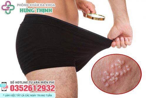 Thân dương vật nổi mụn trắng không ngứa có sao không?