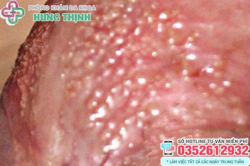 Dương vật nổi mụn trắng gây ngứa là bệnh gì?