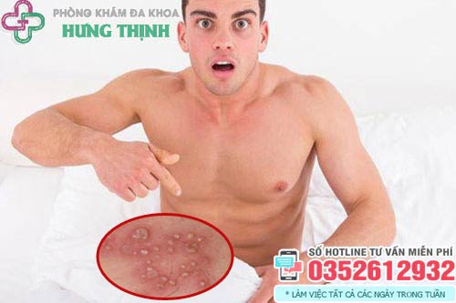 Dương vật nổi mụn trắng nhỏ li ti
