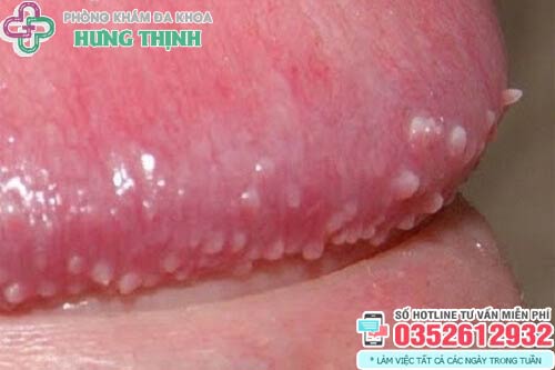 Đầu dương vật nổi mụn trắng không ngứa